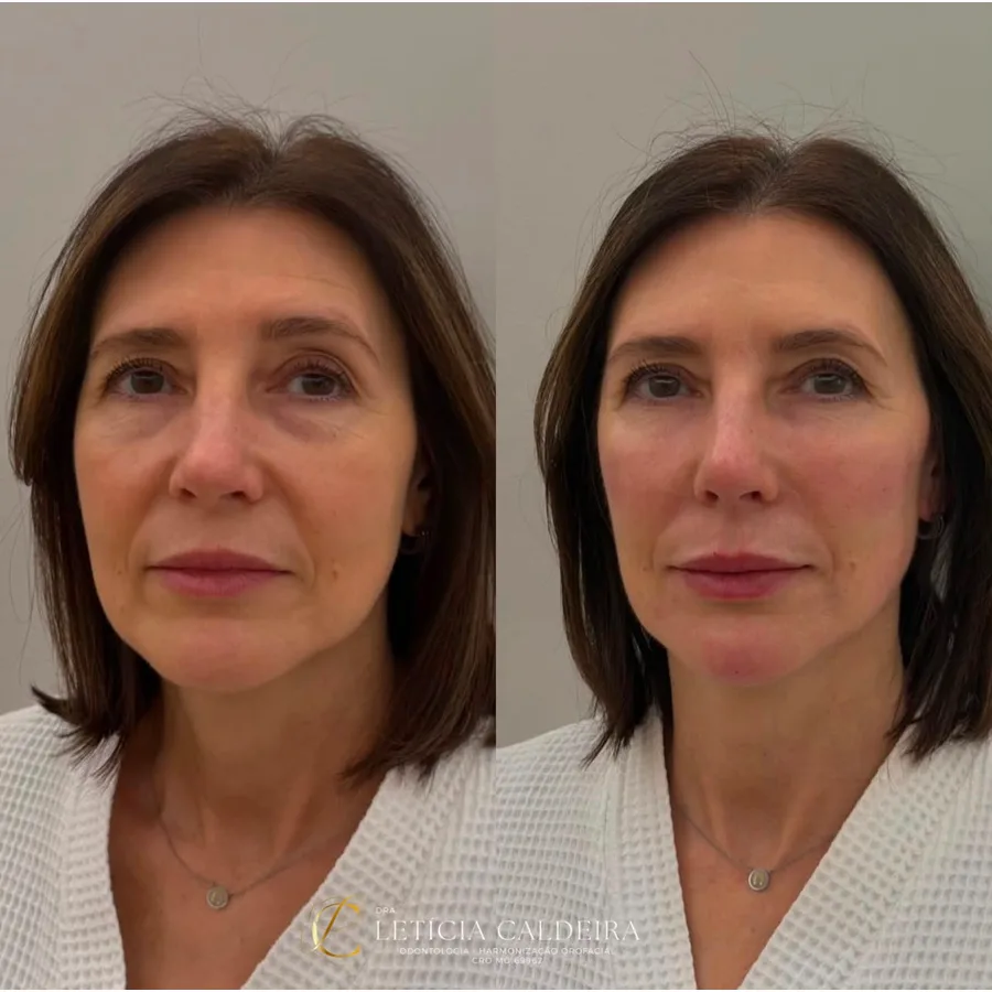 Resultado de harmonização facial Full Face com planejamento individualizado