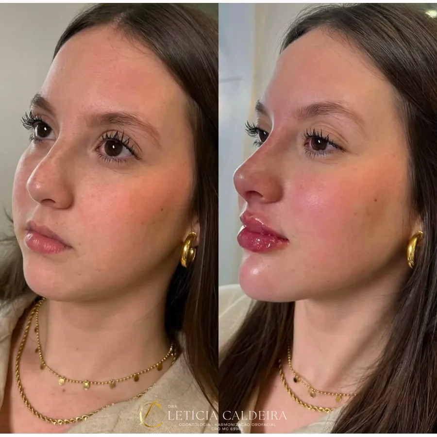 Resultado de perfiloplastia com equilíbrio das proporções do perfil